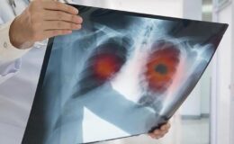 Yılda 41 bin kişi akciğer kanserine yakalanıyor