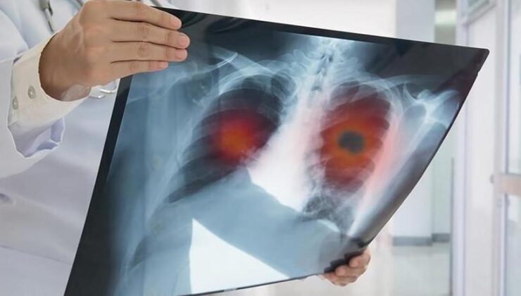 Yılda 41 bin kişi akciğer kanserine yakalanıyor